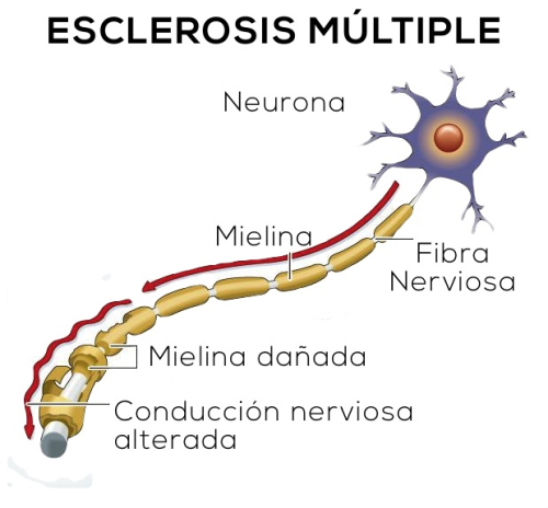 Me han diagnosticado Esclerosis Múltiple, estoy un poco confuso… ¿Qué es la Esclerosis Múltiple?